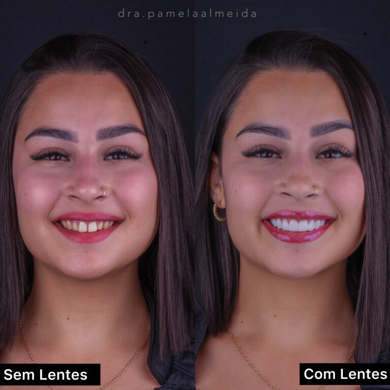lentes de resina antes e depois